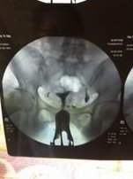 试管期间有什么是不能做的吗？